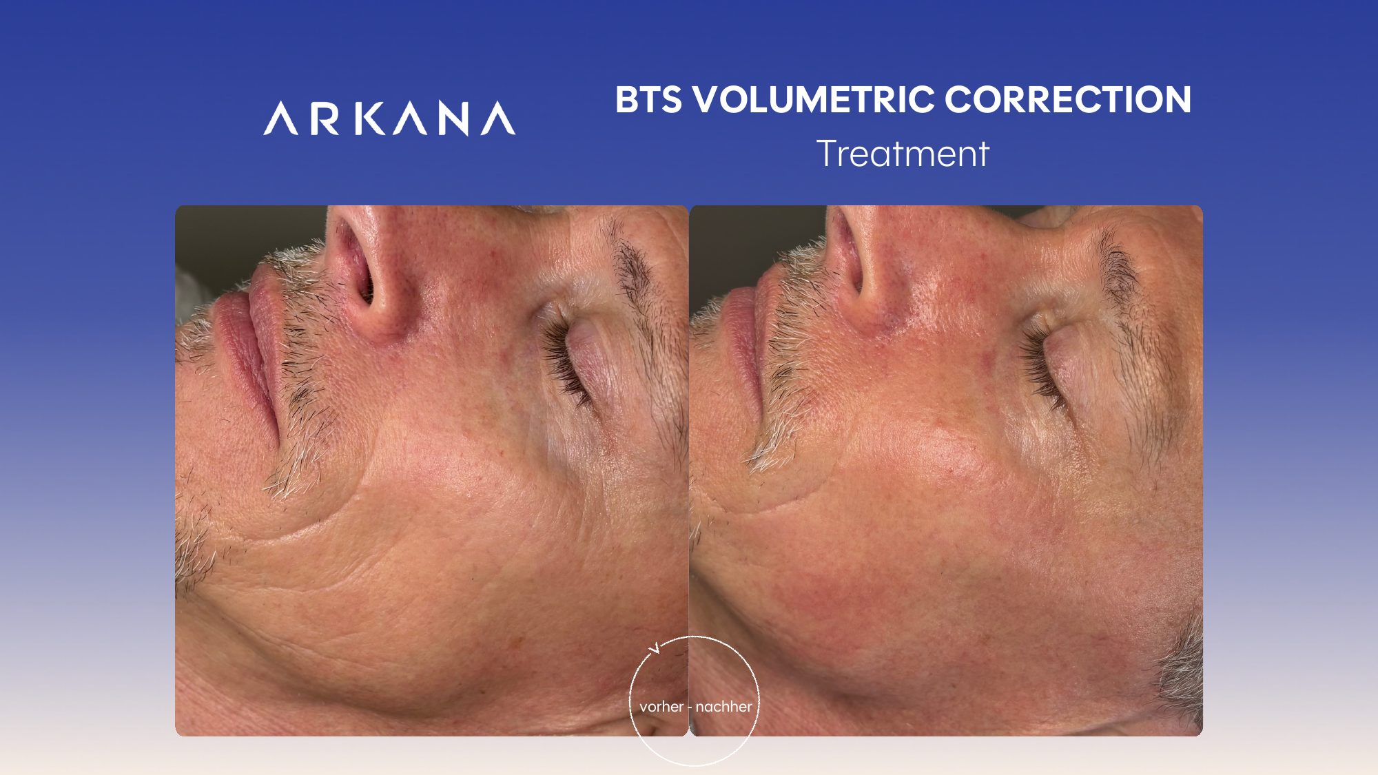 Vorher-Nachher Ergebnis: BTS Volumetric Correction Treatment