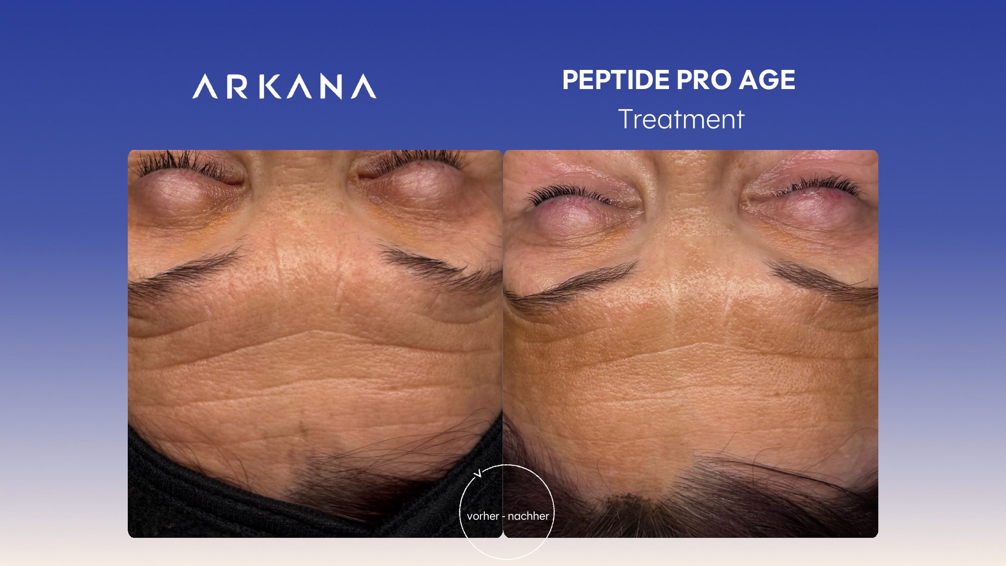 Vorher-Nachher Ergebnis: Peptide Pro Age Treatment