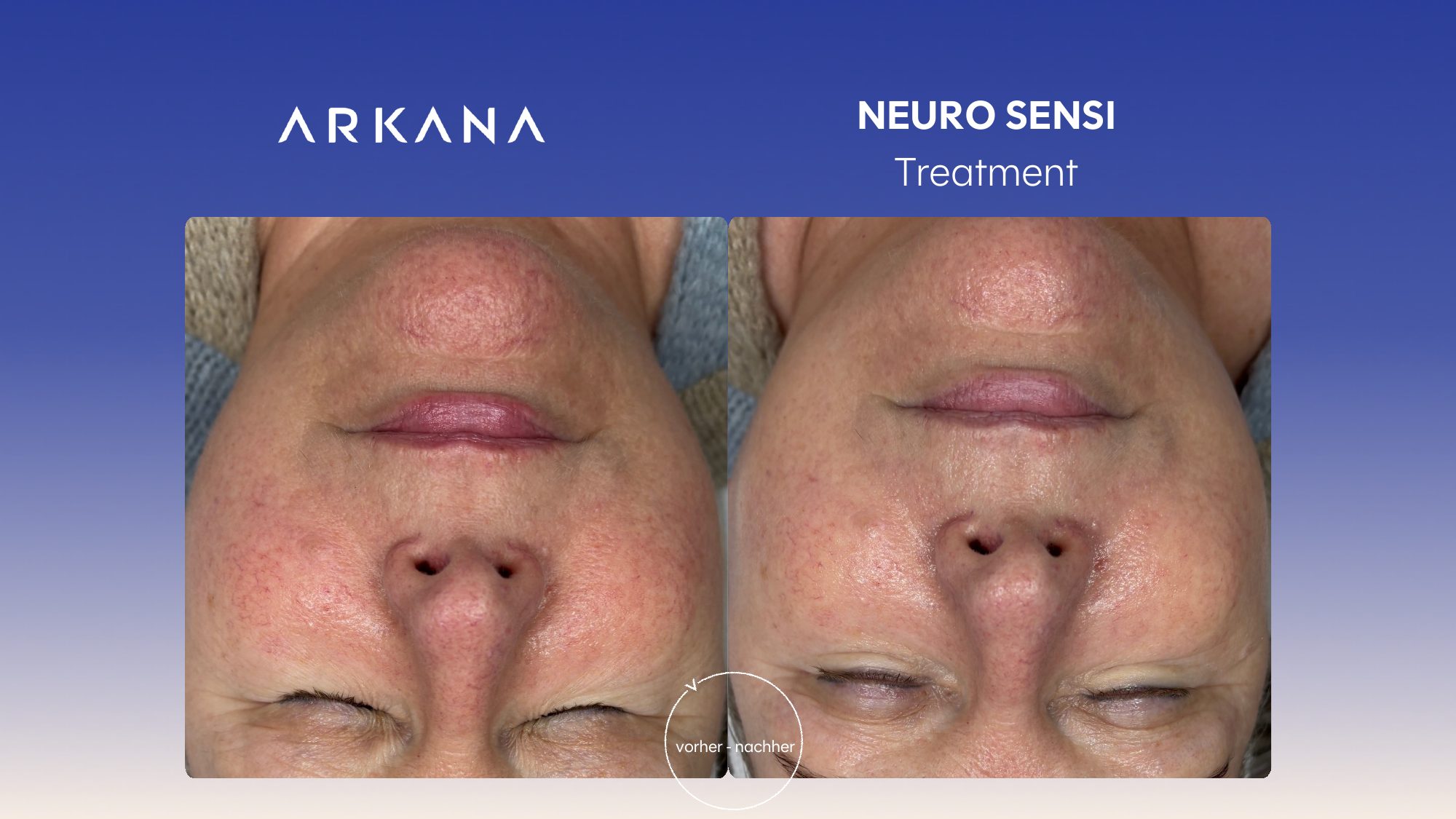 Vorher-Nachher Ergebnis: Neuro Sensi Treatment