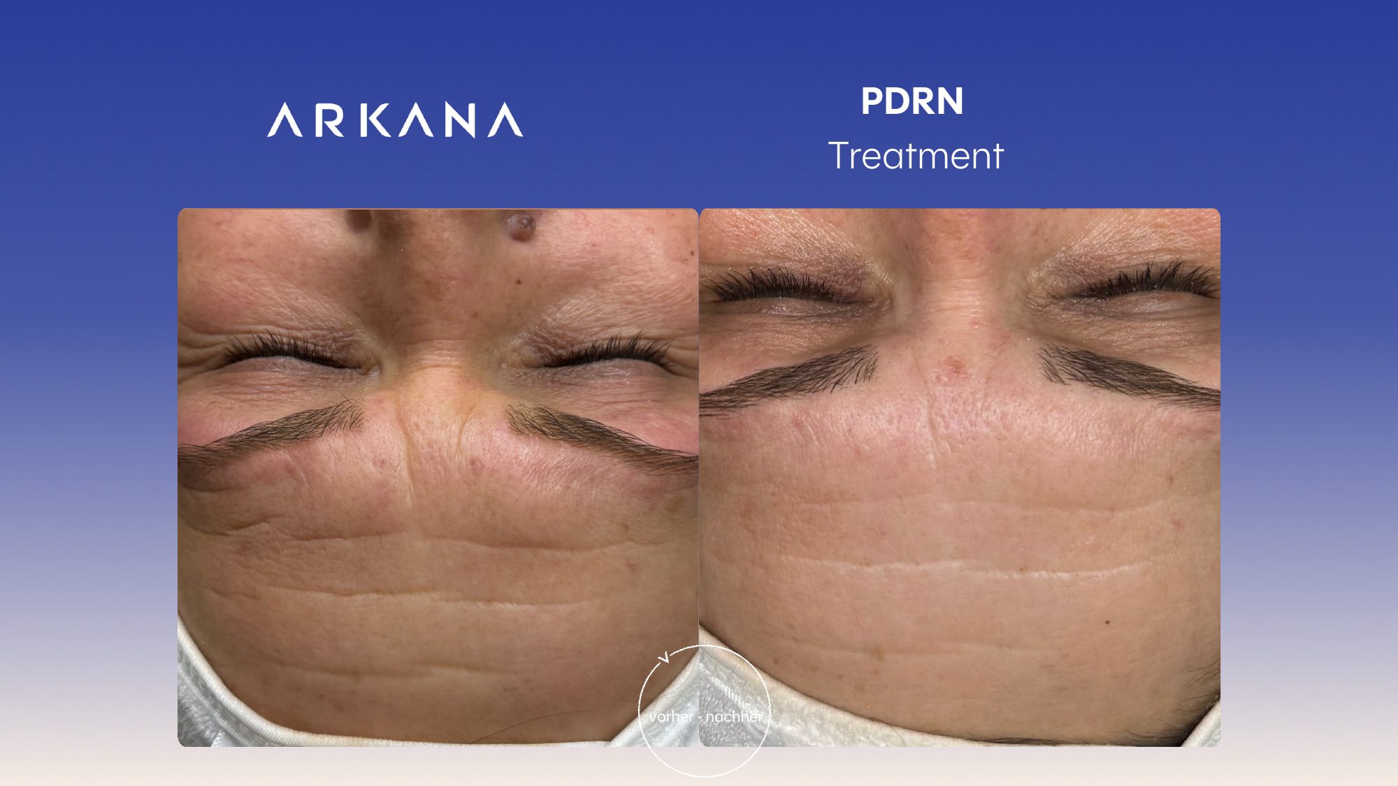 Vorher-Nachher Ergebnis: PDRN Treatment