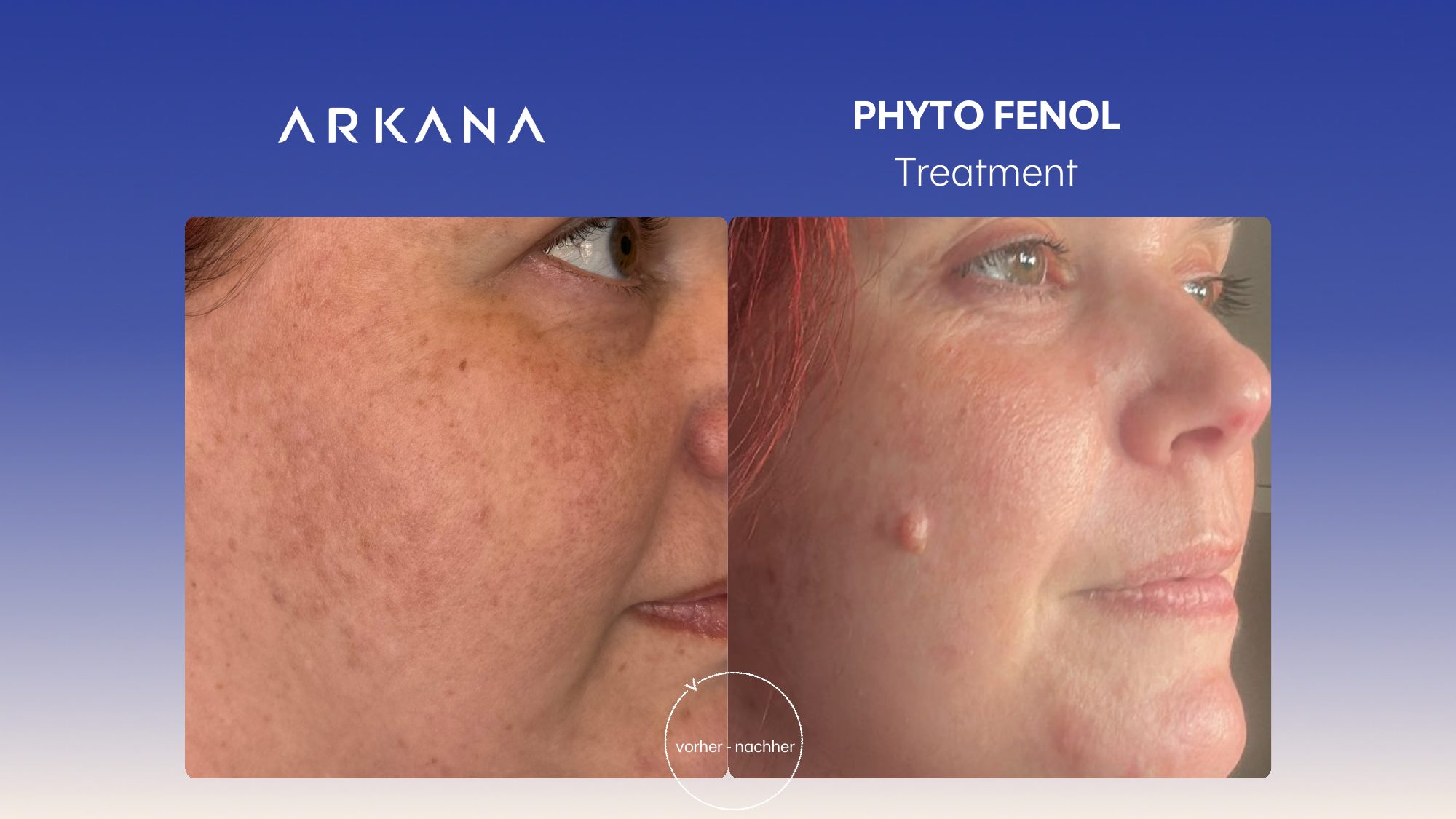 Vorher-Nachher Ergebnis: Phyto Fenol Treatment