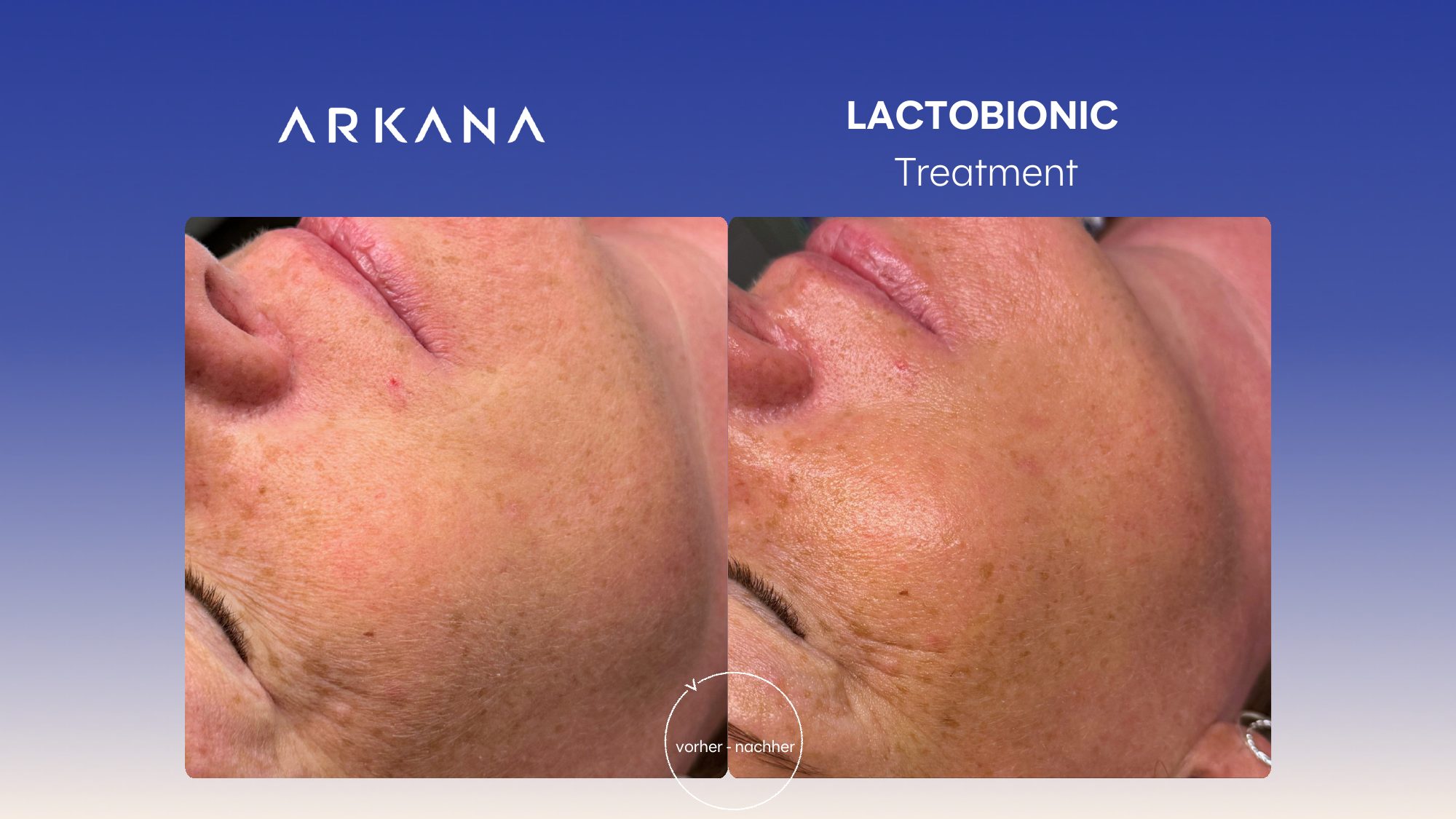 Vorher-Nachher Ergebnis: Lactobionic Treatment